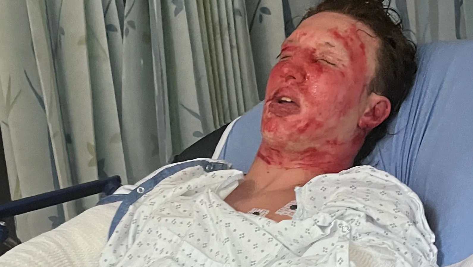 Walker’s Burn Recovery and Support Fund – Fundraiser Donation Help