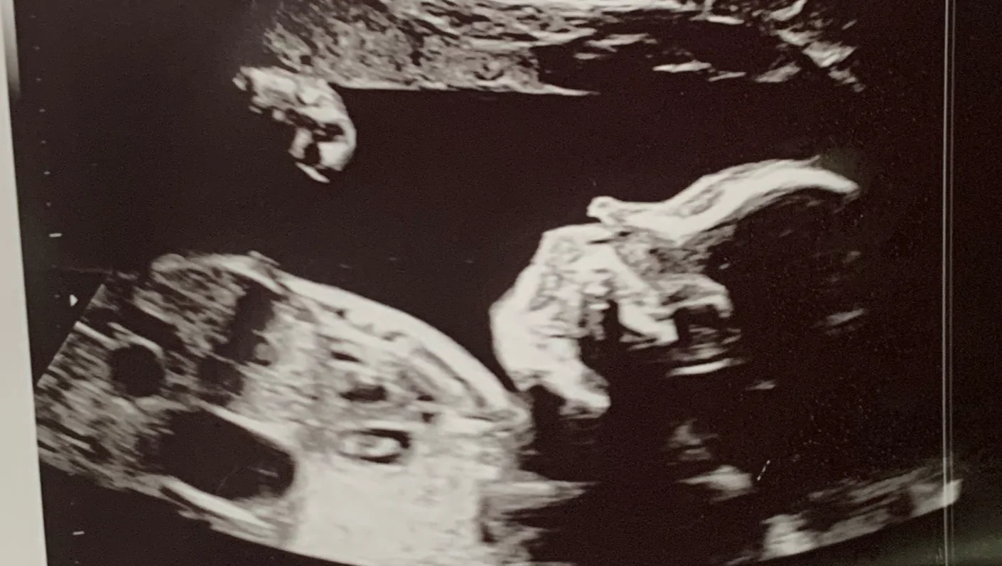 Support Julia and Patrick’s Baby Penny – GoFundMe Fundraiser gofundme Donation Help